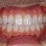 歯石がつきやすい20代女性3ヶ月6回ホワイトニングの症例